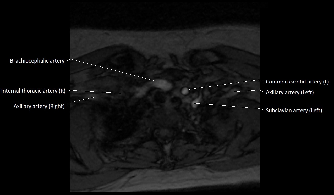 Carotid artery anatomy axial 3T image 72.jpg